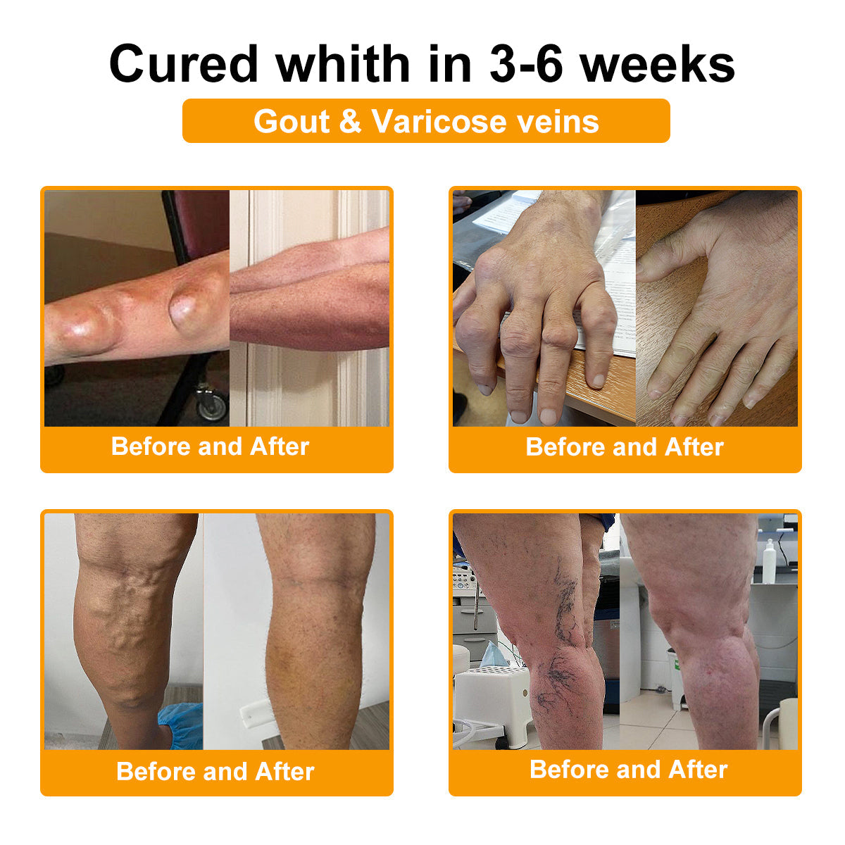 ADNOON® Botulinum Toxin &amp; Bee Venom Pain-Relief Bone Healing Cream