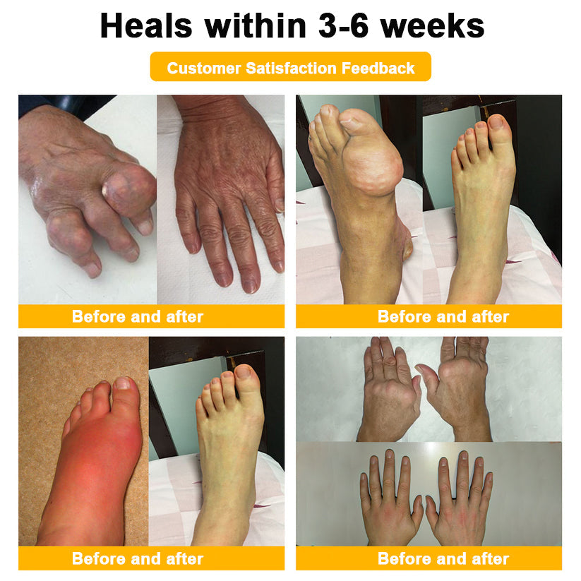 ADNOON® Botulinum Toxin &amp; Bee Venom Pain-Relief Bone Healing Cream